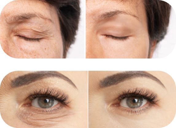 plastyka-powiek w Chojnicach